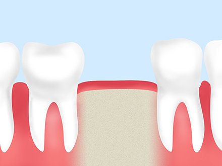 歯を失ってしまったらインプラントで噛む機能を回復しませんか？
